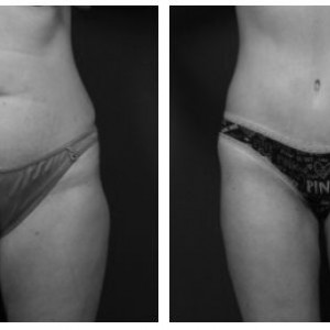 Liposuzione Foto Prima Dopo