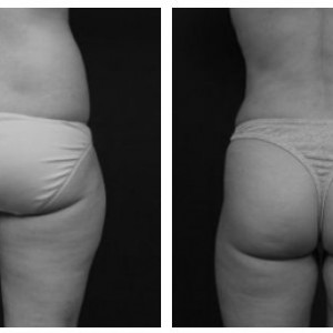 Liposuzione Foto Prima Dopo