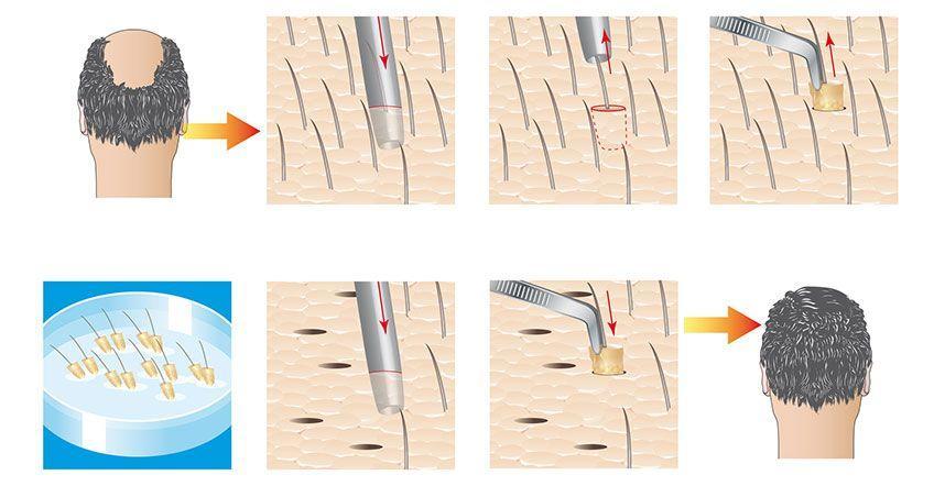 trapianto capelli tecnica